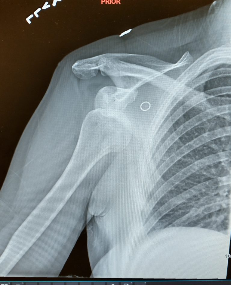 Experiencing A Catastrophic Shoulder Injury From A Physical Therapist's 