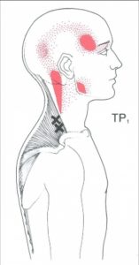 Illustration of cervical trigger points.